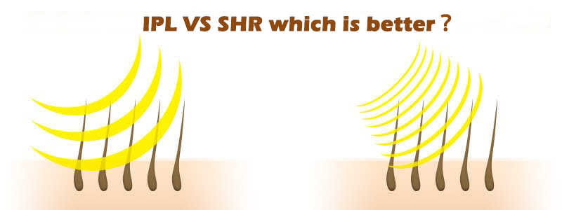 What is the difference between IPL and SHR?